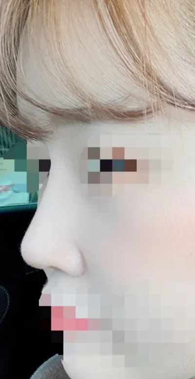 [Хамрын мэс засал] Шаб - Хамар