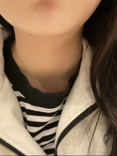 [Жижиг] Эрүүний шугам - Шринк лифтинг