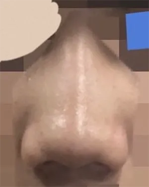 [Хамрын] Гана мэс засал - Хамар