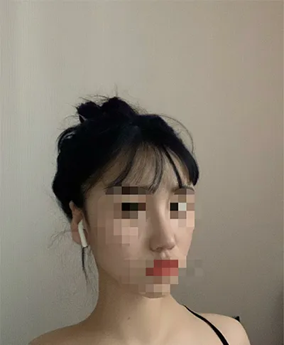 [Хамрын мэс засал] happy1222 - Хамар