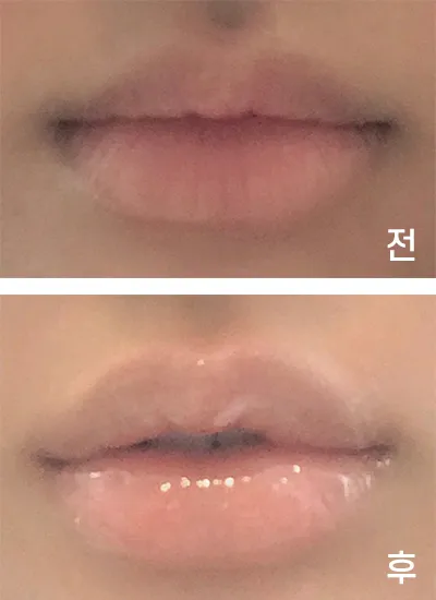 [Бяцхан] ㅎРингㅇ - Уруулын булан, уруулын филлер