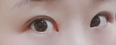 [Нүд] Пингүүжин - Нүдний хэлбэр засах, зүсэлт