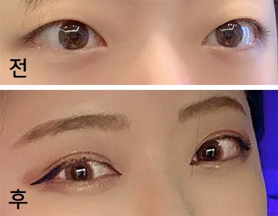 [Нүд] Дээвэр S2 - Дээд зовхины зүслэг, Нүдний хэлбэр засах