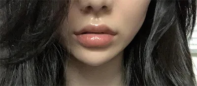 [Бяцхан] Cheeky In ㅇㅇ - Филлер, Лифтинг