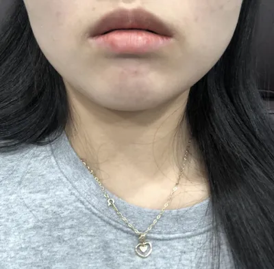 [Жижиг] soosooh - Ботокс, Филлер