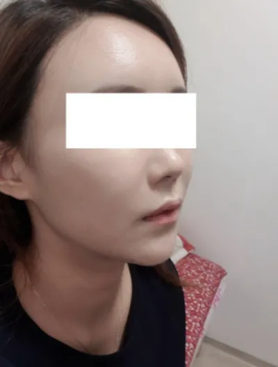 [Anti-aging] 까렁이 - Нүүрний бүх хэсэгт өөх шилжүүлэн суулгах