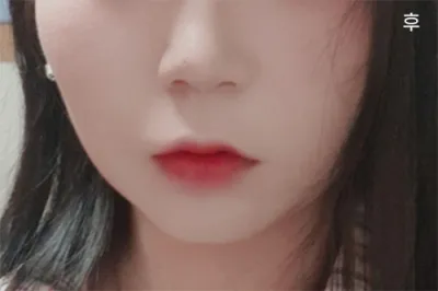 [Анти-Эйжинг] alss12 - Нүүрний өөх соруулах