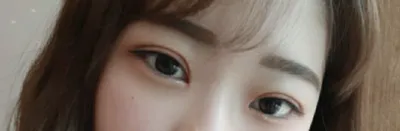 [Нүд] msdmsquf2 - Далд оёдол, Дээд зовхины өргөлт