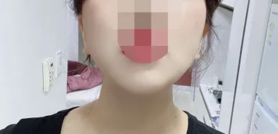 [Өөх соруулах] B Mask-гүй - Нүүрний өөх соруулах