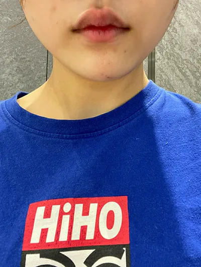 [Бяцхан] Жиюнс - Дөрвөлжин эрүүний ботокс