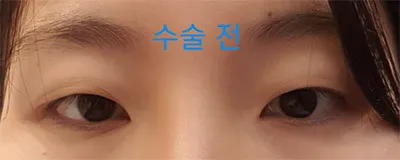 [Нүд] Шууд цацах арга - Нүд