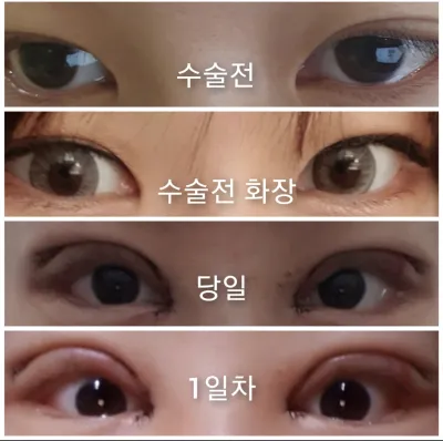 [Нүд] Гогиён - Давхар зовхи, дээд зовхины өргөлт, доод зовхины өргөлт