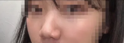 [Хамрын мэс засал] Яагаад утсаа авахгүй байгаа юм бэ? - Хамар