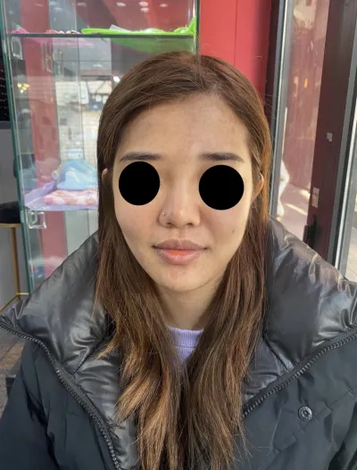 [Анти-Эйджинг] ppkim0119 - Өөх шилжүүлэн суулгах