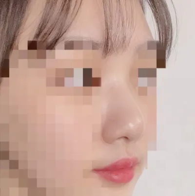 [Хамрын] Лонгдаранса - Хамрын гоо сайхны мэс засал