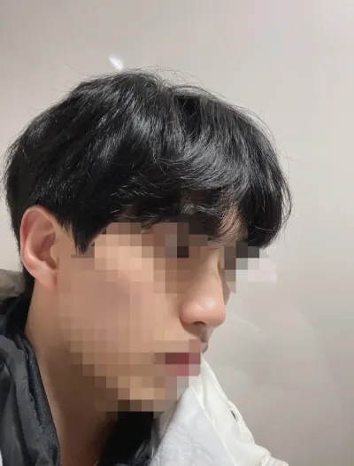 [Хамрын мэс засал] Минъяаяа - Хамар (силикон, хамар хоорондын мөгөөрс)