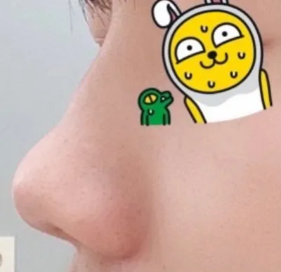 [Хамрын мэс засал] Бишоншоншоншол - Хамар