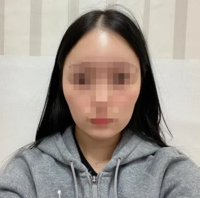 [Нүүрний хэлбэр засах мэс ажилбар] Лемон55 - Дөрвөлжин эрүүний мэс засал, эрүүний үзүүр багасгах