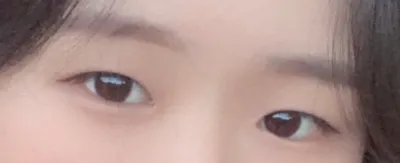 [Нүд] 0202u - Дээд зовхины зүслэг, Давхар зовхи