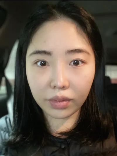 [Нүүрний хэлбэр засах мэс засал] Маршалл спикер - Нүүрний хэлбэр засах 3 төрлийн мэс засал