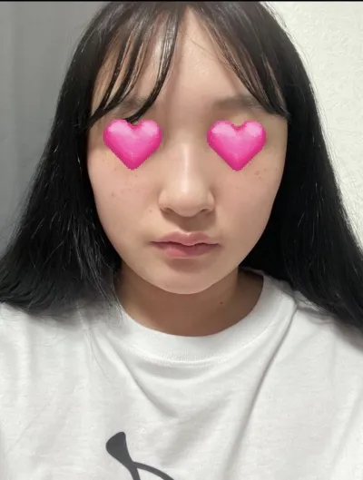 [Хамрын мэс засал] Минкаин - Хамар