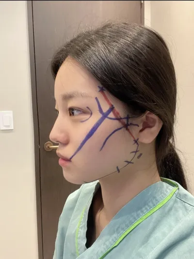 [Нүүрний контур] Гванжугийн гүнж гүнж - Шанаа, эрүүний үзүүр, дөрвөлжин эрүү