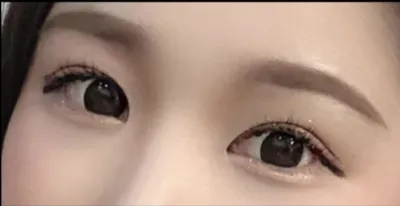 [Нүд] sidhd22 - Арын болон доод зовхины тайралт