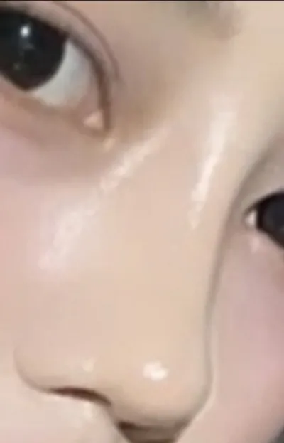 [Хамрын мэс засал] Мэронманго - Хамар