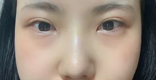 [Хамрын мэс засал] Ягаан Панда - Нүд, хамар