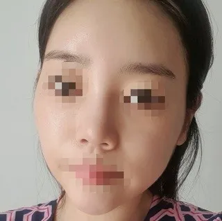 [Хамрын мэс засал] Ягаан өнгө - Хамар, Контур