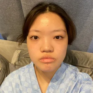 [Хамрын мэс засал] Эльза - Нүд, хамар