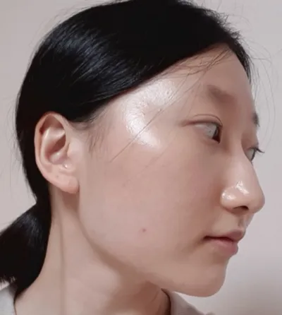 [Хамрын мэс засал] Өнгө үзэмж - Хамар