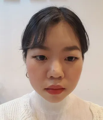 [Хамрын мэс засал] Цахлай хэлбэртэй хамар - Нүд, хамар