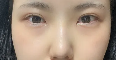 [Нүд] Эвэртэй - Нүд, Хамар