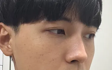 [Хамрын мэс засал] Нэг сарын дараа - Хамар, нүүрний хэлбэр