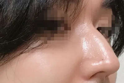 [Хамрын мэс засал] Робот - Хамар