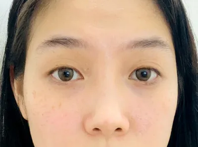 [Нүд] Бетгэл - Нүд, Хамар