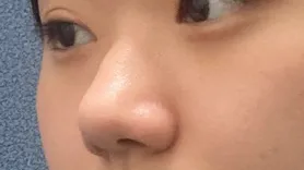 [Хамрын мэс засал] Өр төлбөртэй бөгөөд сэтгэл хангалуун - Хамар, шанаа