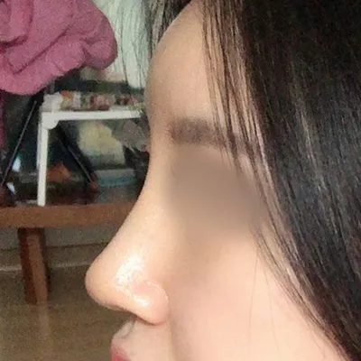 [Хамрын мэс засал] LIVIUS - Хамар