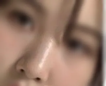 [Хамрын] Хамрын мэс засал - Хамар