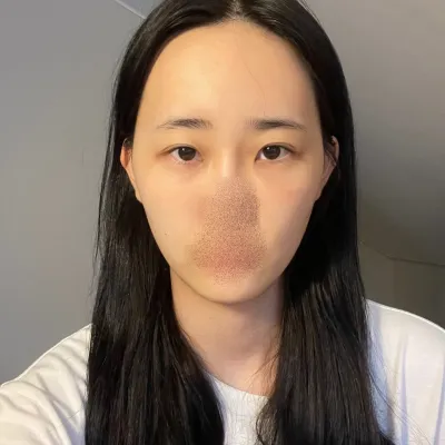 [Нүд] Самсам Оюу - Нүд, Өөх шилжүүлэн суулгах, Контур