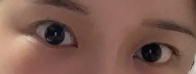 [Нүд] Супиан - Нүд, Өөх шилжүүлэн суулгах