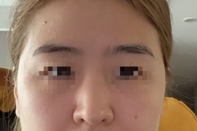 [Хамрын мэс засал] Мёнжис - Хамар, Өөх шилжүүлэн суулгах