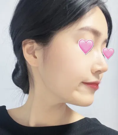 [Хамрын мэс ажилбар] Беби Фокс - Хамар