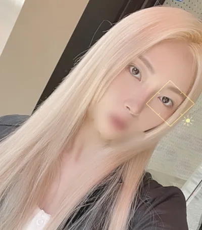 [Хамрын мэс засал] Элиша - Хамар, нүдний доод өөхөн эдийг нүүлгэн шилжүүлэх