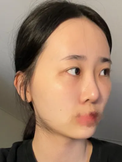 [Нүд] Бамбарууш - Нүд, контур, өөх шилжүүлэн суулгах