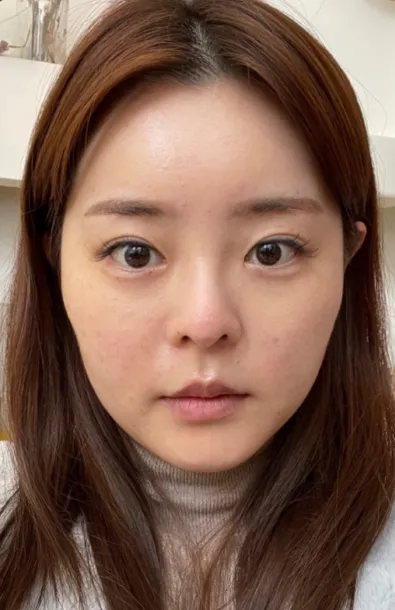 [Нүд] Туулай - Нүд, хамар, контур, нүүрний өөх соруулах