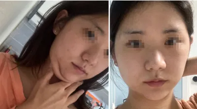 [Нүүрний хэлбэр засах мэс засал] Салфетка - Контур, хамар