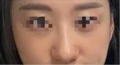 [Хамрын мэс засал] Райни - Хамар