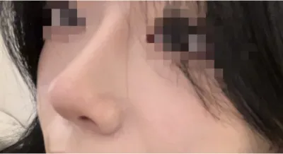 [Хамрын] Шилэн хэлтэрхий - Хамар